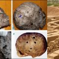 Evidences of brain surgery being done during Bronze Age have been found in Harappa.