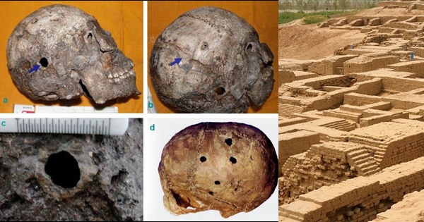 Evidences of brain surgery being done during Bronze Age have been found in Harappa.